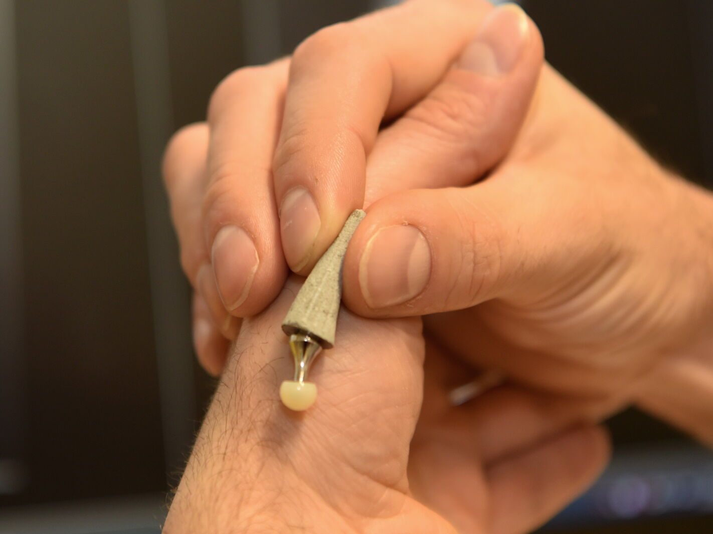 Arthrose im Daumen: Expertinnen und Experten der Handchirurgie am Bergmannsheil raten bei dieser Diagnose zur Daumenendoprothese. Bildnachweis: BG Universitätsklinikum Bergmannsheil Daumenendoprothese